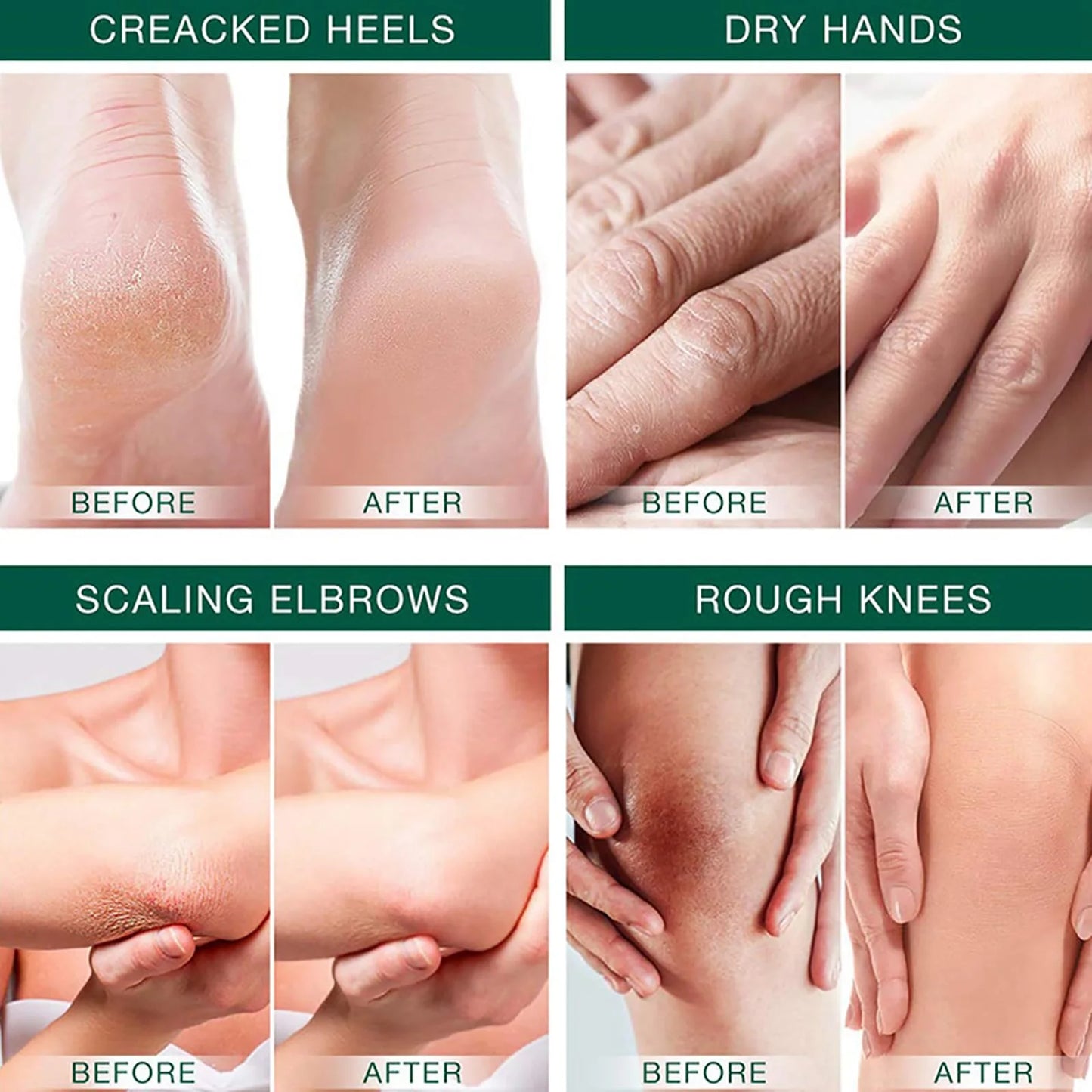 Urea Cream 42%, Foot Cream For Dry Cracked Heels, Urea Cream 42 Percent For Feet, Moisturizing & Exfoliating Foot Cream With 2% Peaceful Pleasures Health and Wellness