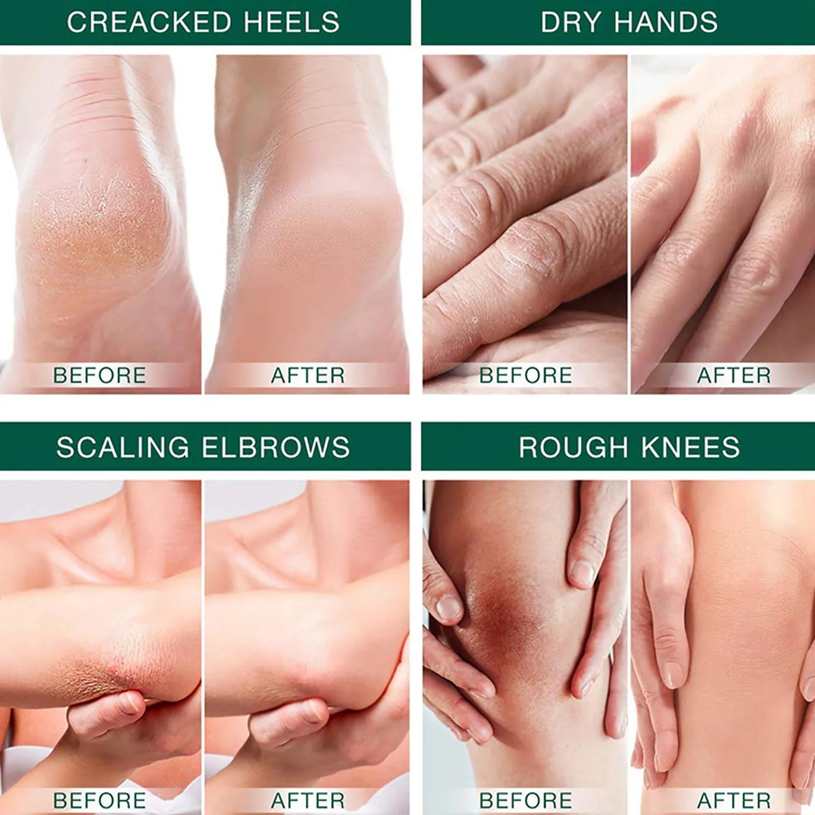 Urea Cream 42%, Foot Cream For Dry Cracked Heels, Urea Cream 42 Percent For Feet, Moisturizing & Exfoliating Foot Cream With 2% Peaceful Pleasures Health and Wellness