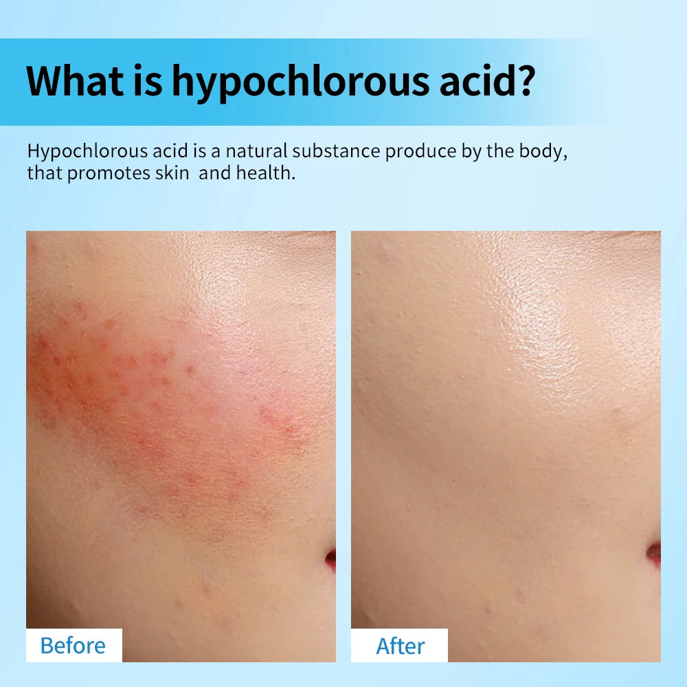 Hypochlorous Acid Facial Spray Reduce redness swelling acne Versatile uses for every skin Calm Redness Eyelid lrritation Care Sk Peaceful Pleasures Health and Wellness