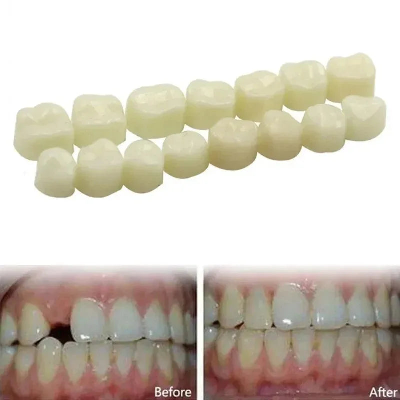 5 Boxes Dental Teeth Veneers Whitening False Denture Resin Temporary Crown Replacement Kit Porcelain Dental Material Oral Care Peaceful Pleasures Health and Wellness