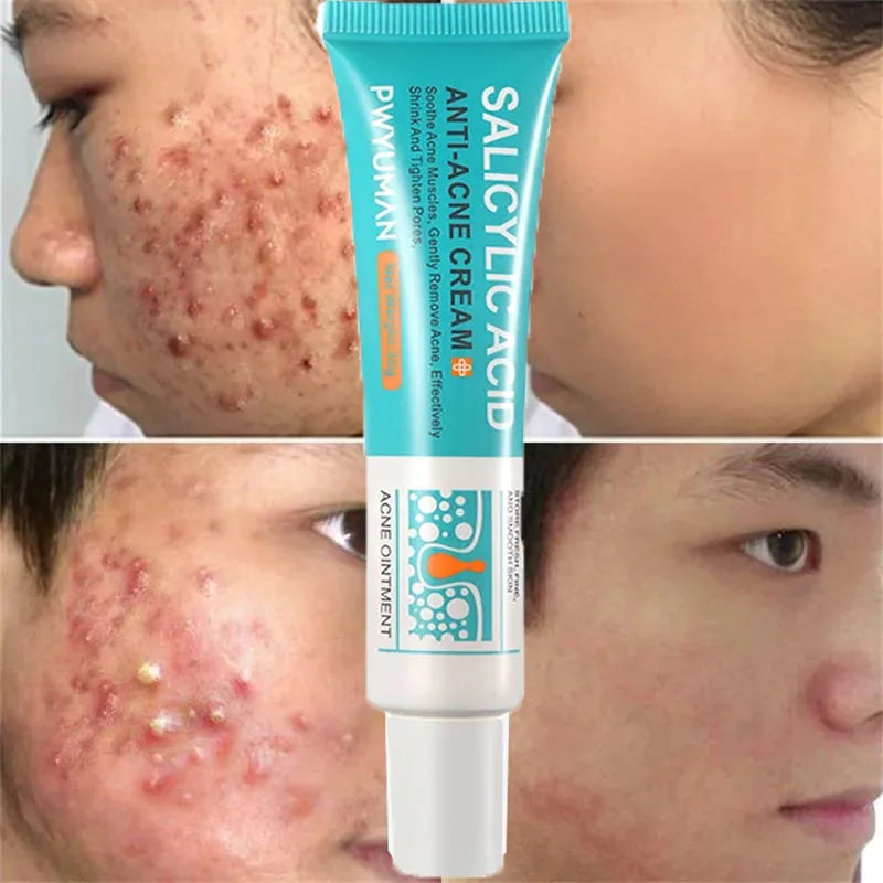 Salicylic Acid Acne Removal Cream Anti-Acne Repair Redness Pimple Spots Deep Cleaning Pore Oil Control Moisturizing Skin Care Peaceful Pleasures Health and Wellness