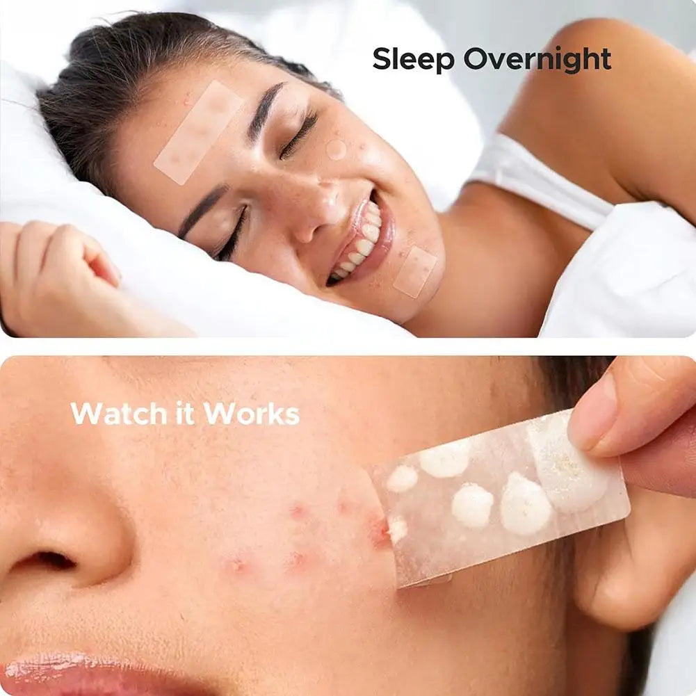 Hydrocolloid Pimple Patches – Mixed Sizes Invisible Acne Spot Stickers for Zits, Spots & Blemishes Peaceful Pleasures Health and Wellness