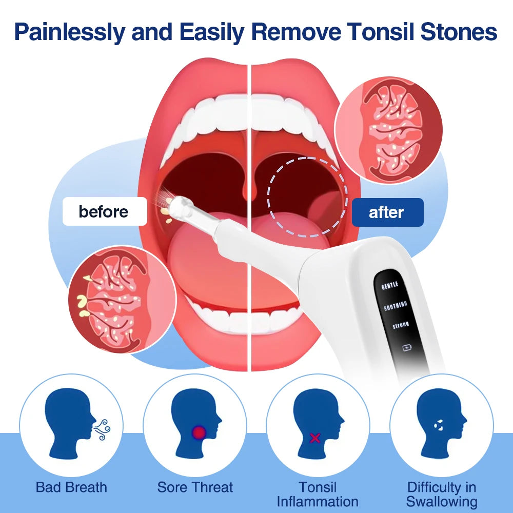 Tonsil Stone Remover Tool Electric Vacuum Tonsil Stone Removal Kit LED Light & 3-Level Suction Tonsil Cleaner Anti Bad Breath Peaceful Pleasures Health and Wellness