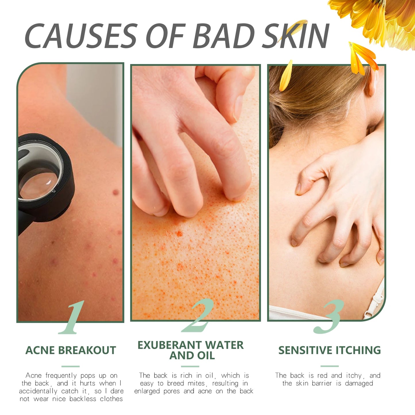 Keratosis Pilaris Repair Cream | Chicken Skin Body Lotion 48g