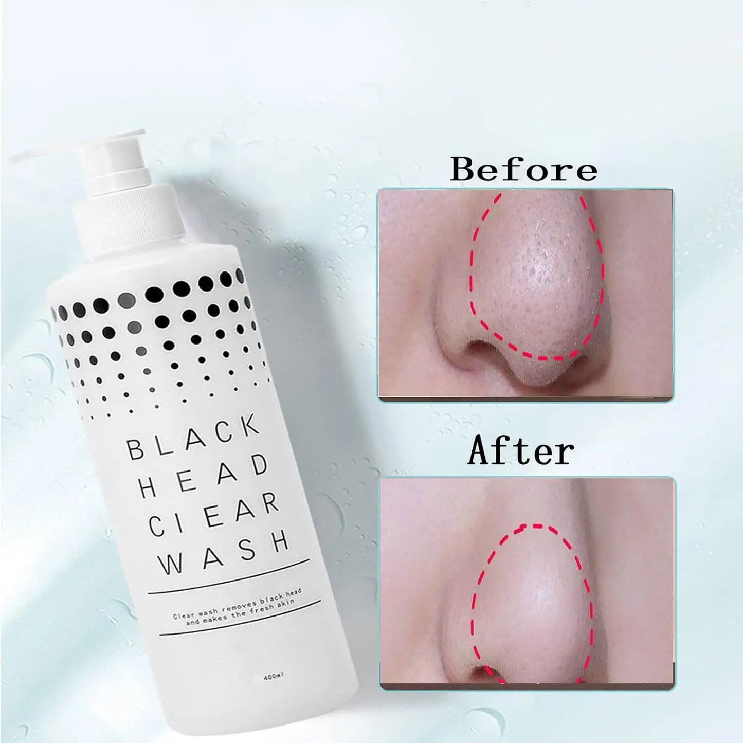 400ml Facial Exfoliation Liquid – Deep Pore Cleansing Treatment