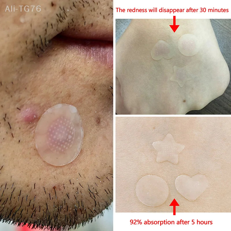 Salicylic Acid Microneedle Acne Patches | Blemish Treatment