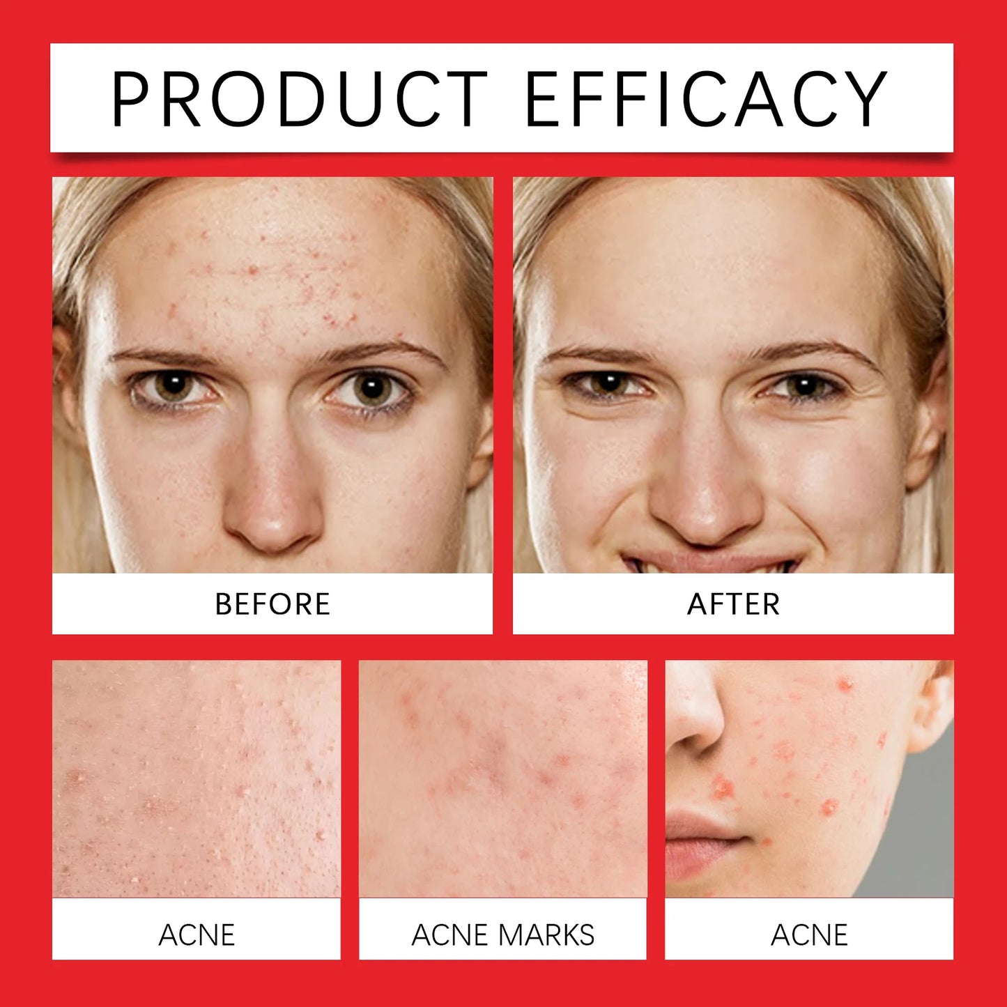 Hydrocolloid Acne Patches 200pcs | Star-Shaped Blemish Dots