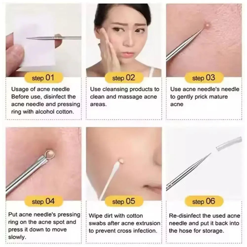 4-Piece Blackhead Remover Tool Set – Stainless Steel Peaceful Pleasures Health and Wellness