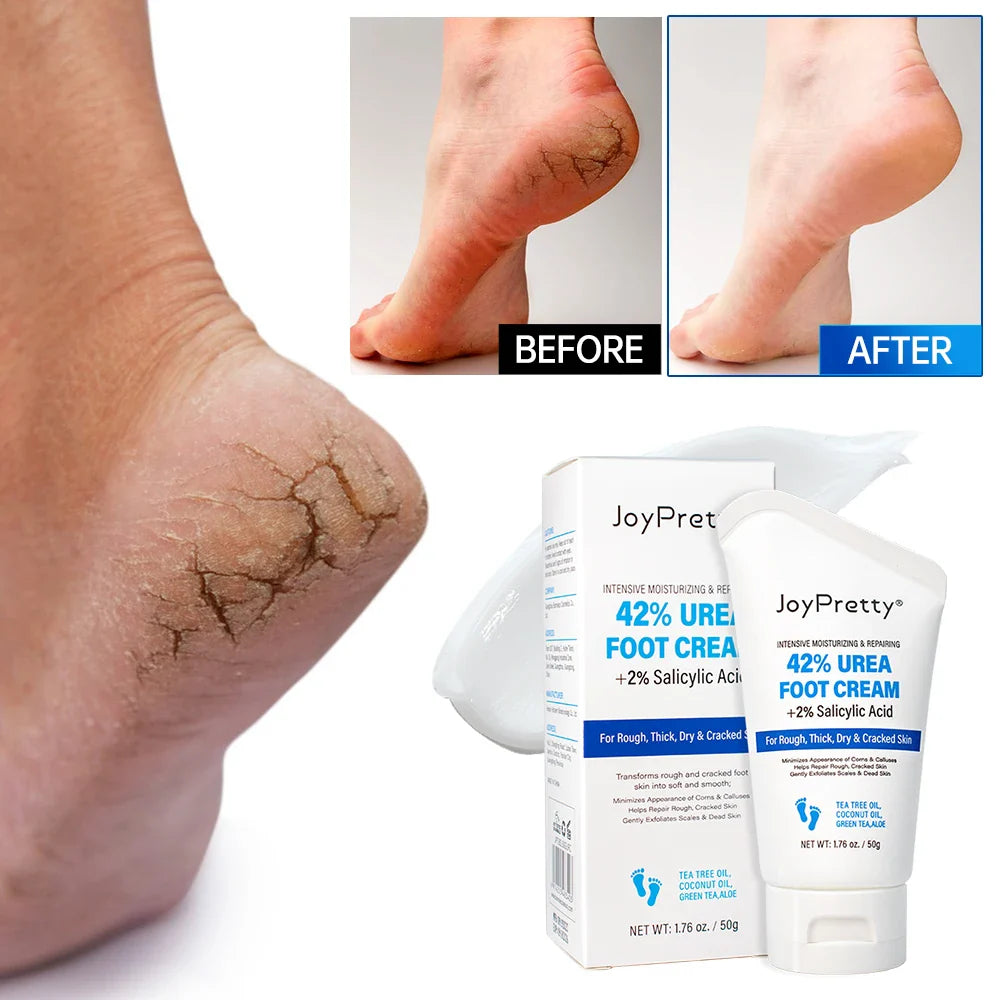 JoyPrettyin 42% Urea Foot Cream – Exfoliating & Moisturizing