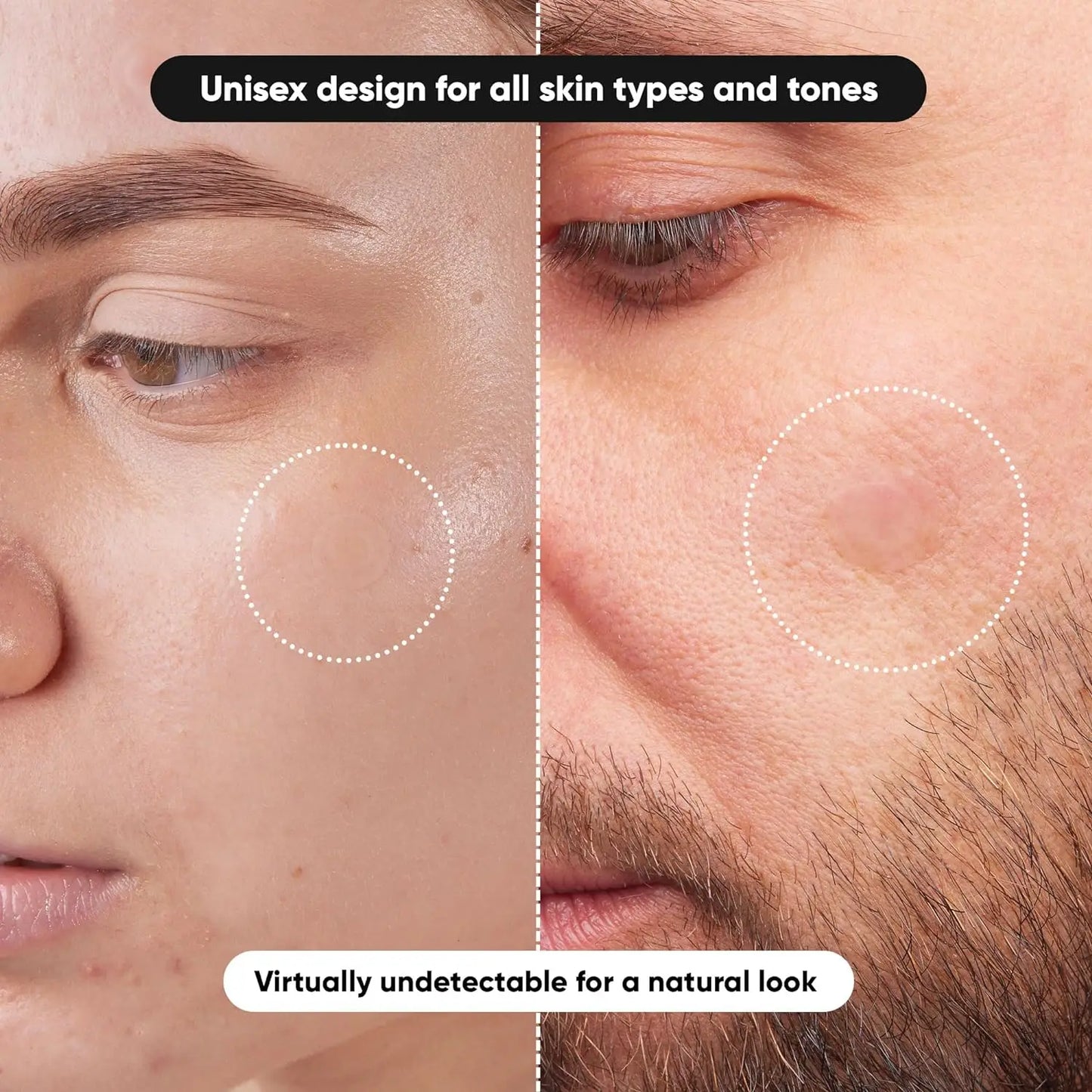 Hydrocolloid Acne Patches 216/720pc | Alcohol-Free Blemish Dots