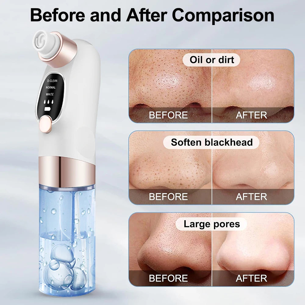 Blackhead Remover Pore Vacuum Cleaner Face Black Dot Pimple Acne Remover Electric Blackhead Vacuum Cleaner Black Point Extractor Peaceful Pleasures Health and Wellness