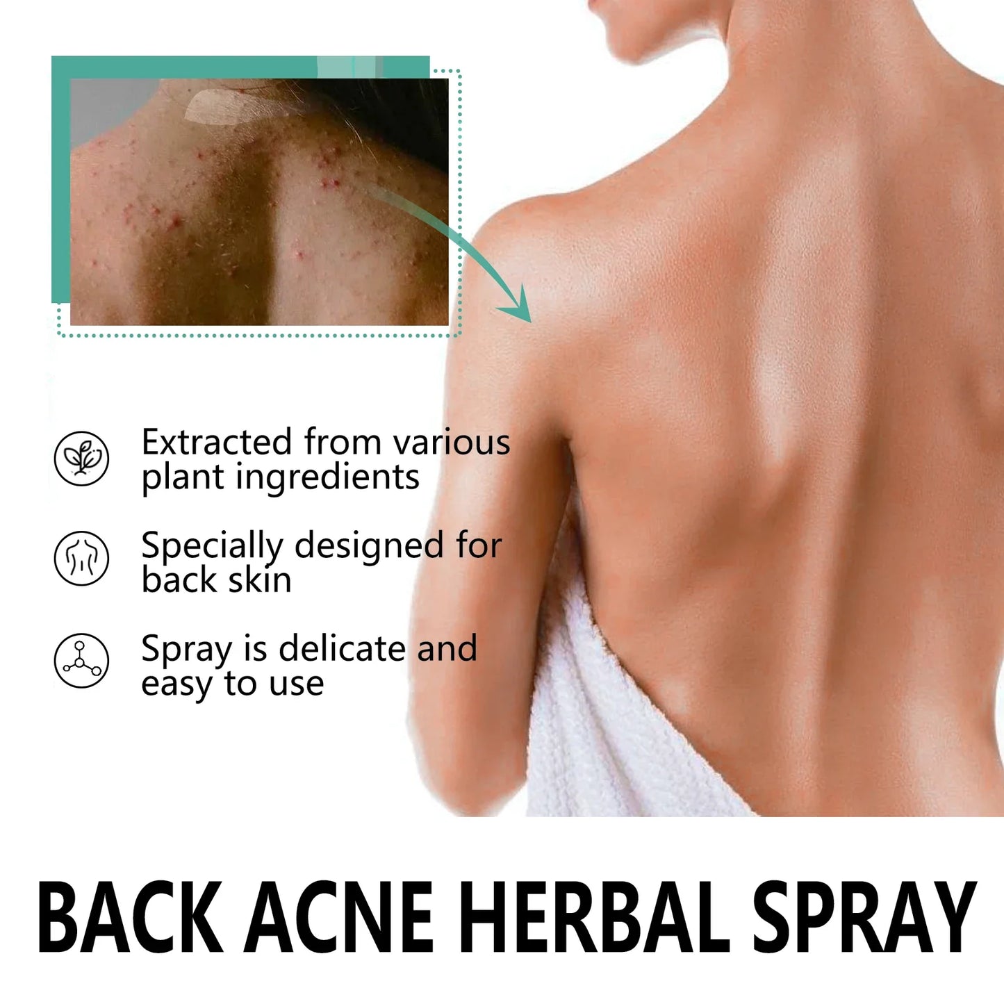 OceAura Herbal Acne Spray – Back, Shoulder & Pore Treatment