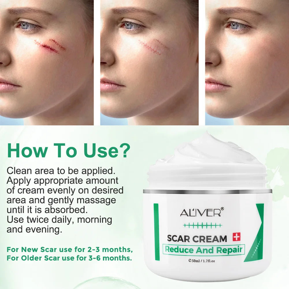 ALVER Acne Scar & Stretch Mark Remover Cream – 50ml Peaceful Pleasures Health and Wellness