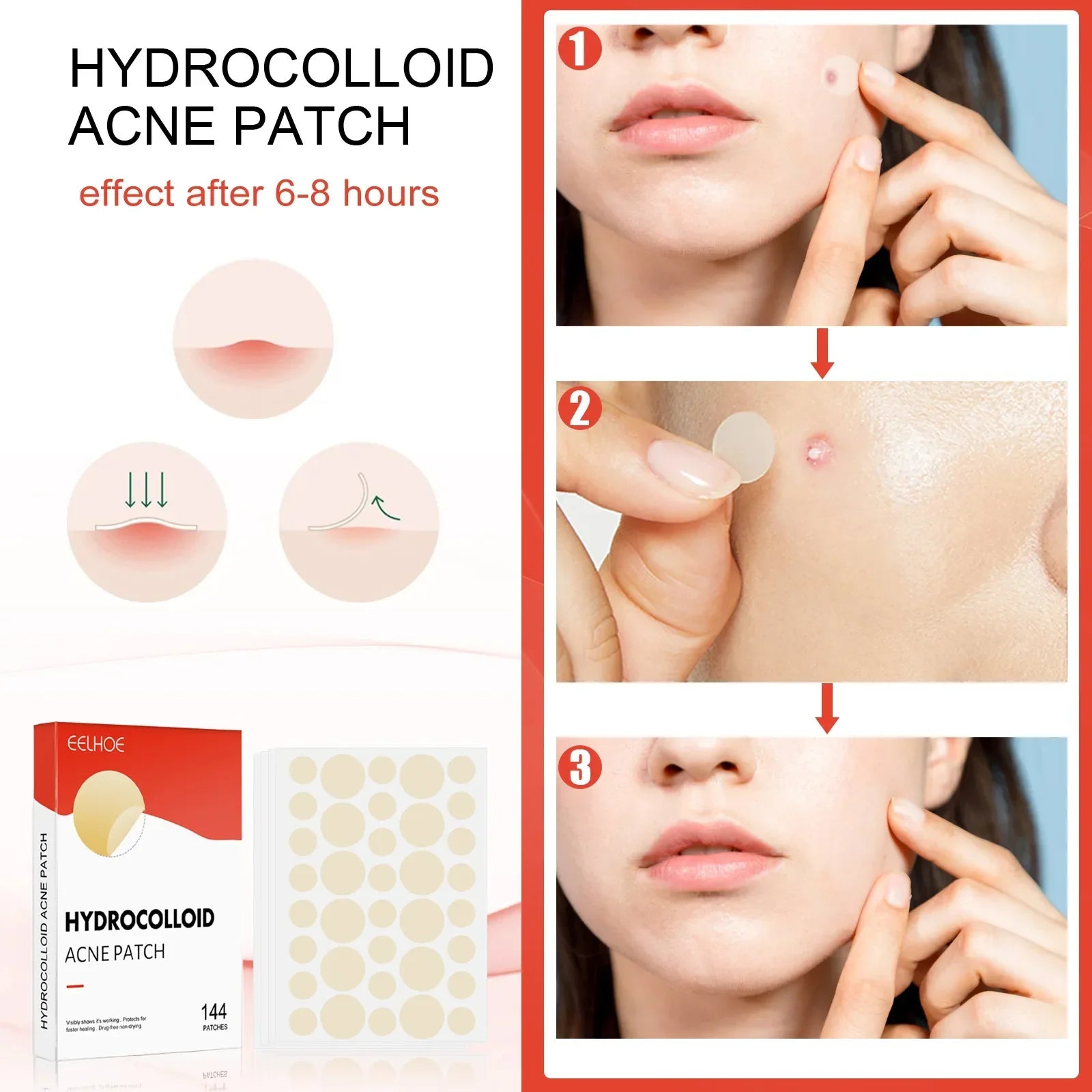 Hydrocolloid Acne Patches – 144pc Invisible Pimple Cover Peaceful Pleasures Health and Wellness