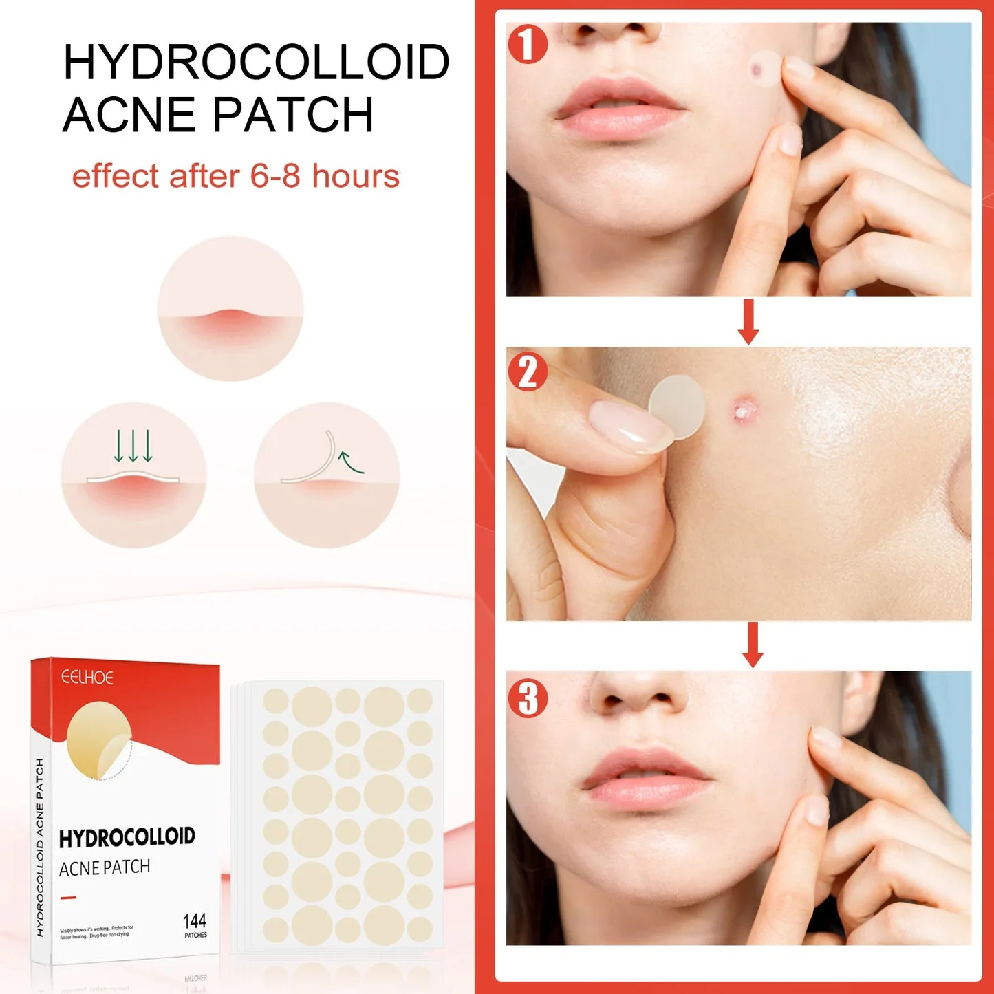 Eelhoe 144-Pc Hydrocolloid Acne Patches – Invisible Pimple Cover
