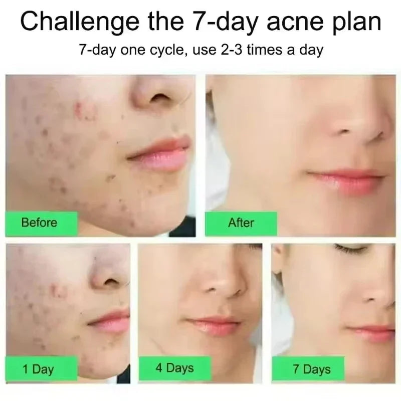 SADOER Salicylic Acid Acne Cream – Oil Control & Pore Minimizer