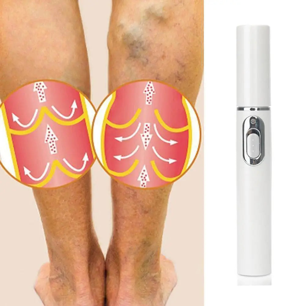 Skin Tag Removal Pen, Mole And Wart Removal Pen High-quality Anti Swelling Vessel Bulge Pain Blood Circulation Peaceful Pleasures Health and Wellness