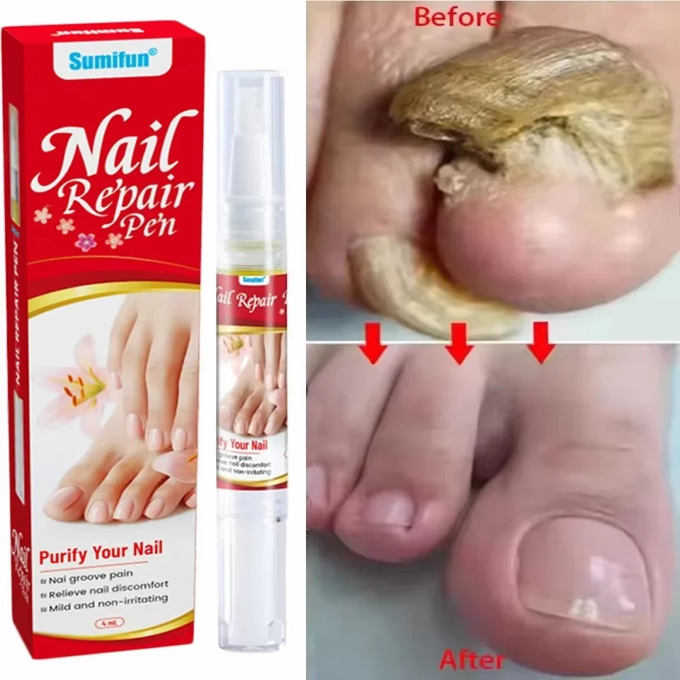 Fungal Nail Treatment Serum Foot Nail Fungus Removal Repair Gel Anti Infection Paronychia Onychomycosis Foot Nails Care Essence Peaceful Pleasures Health and Wellness