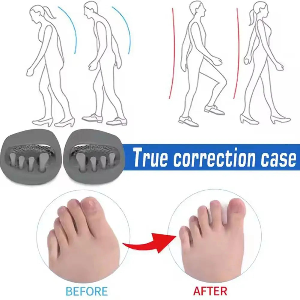 New Adult O X Type Leg Correction Slippers Insoles Bow Leg Valgus Varus Orthotic Device for Men Women Daily Use Daily Correction Peaceful Pleasures Health and Wellness