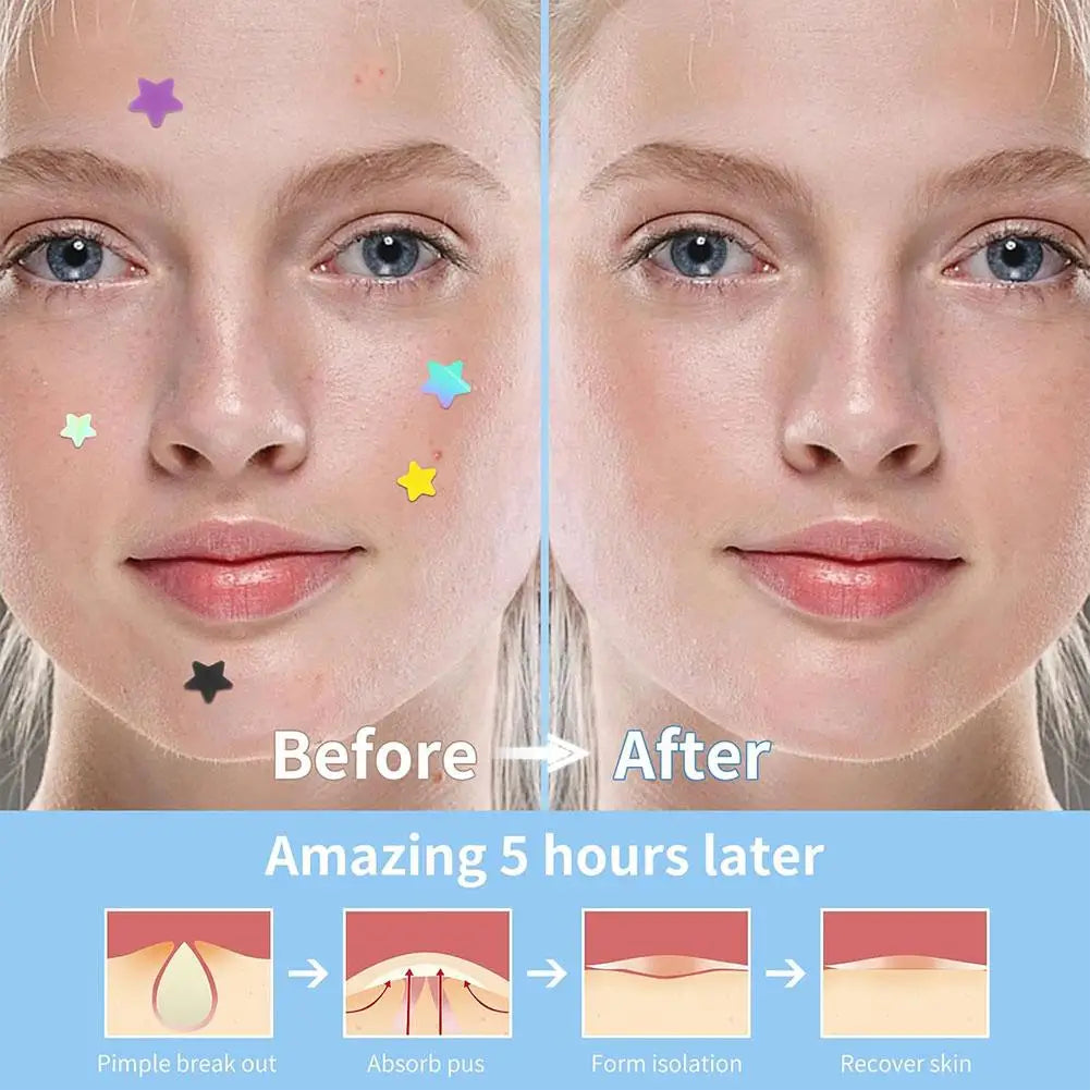eelhoe Colorful Hydrocolloid Acne Pimple Patches – Cute Star & Heart Shaped Blemish Cover Stickers | 168–252 Pcs Peaceful Pleasures Health and Wellness