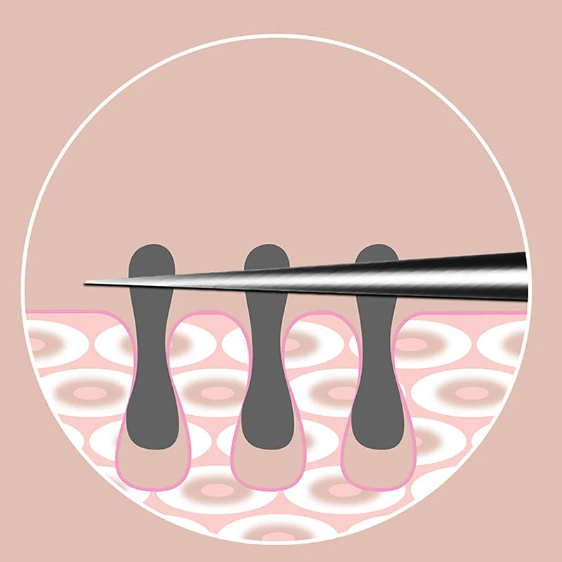 1pc 8CM Cell Pimples Blackhead Clip Tweezers Beauty Salon Special Scraping Closing Artifact Needle Tool Peaceful Pleasures Health and Wellness
