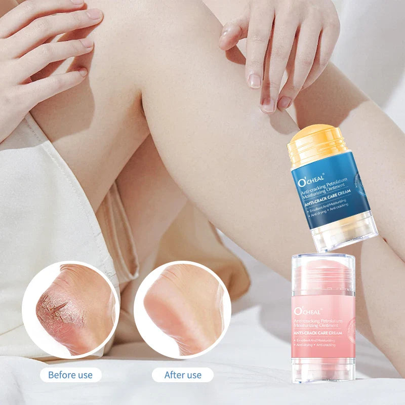Anti-Crack Foot Cream for Dry & Cracked Heels – Moisturizer