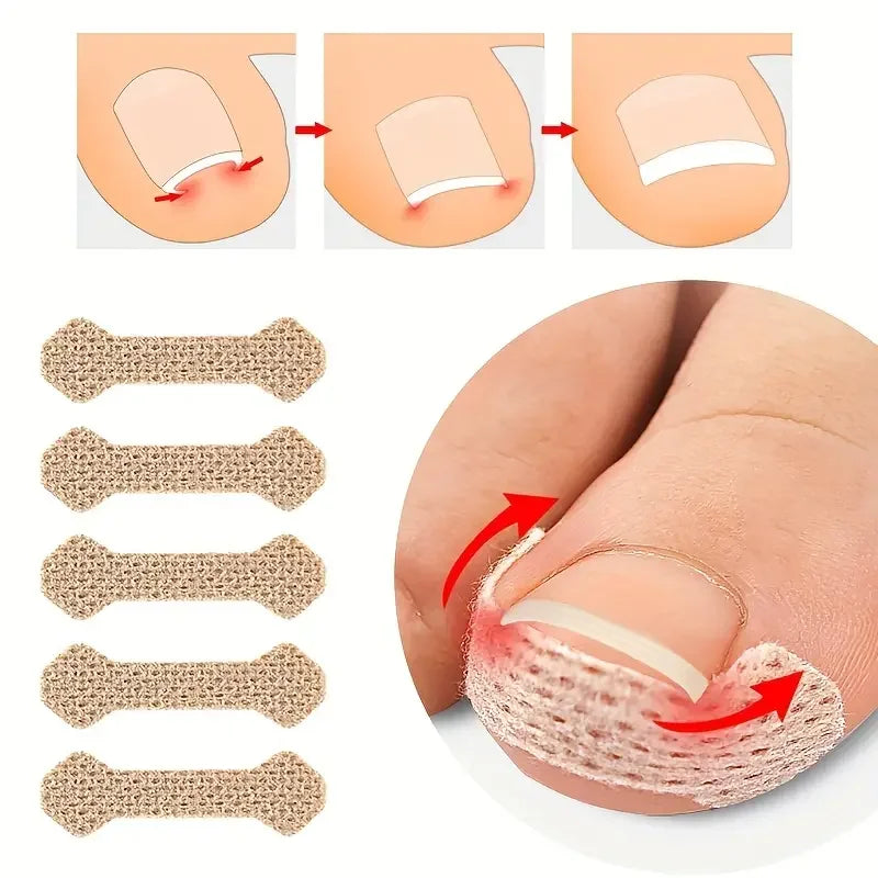 0pcs Toe Patch Set Get Relief from Ingrown Toenails & Enhance Nail Care with Orthopedic Support Nail pulling patch orthotics Peaceful Pleasures Health and Wellness 20 pcs
